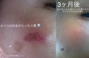 【サマーキャンペーン】臍帯幹細胞美容液・エクソソーム・クリーム